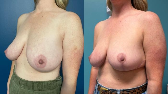 Breast Reduction Before & After Photo | San Francisco, CA | Kaiser Permanente Cosmetic Services