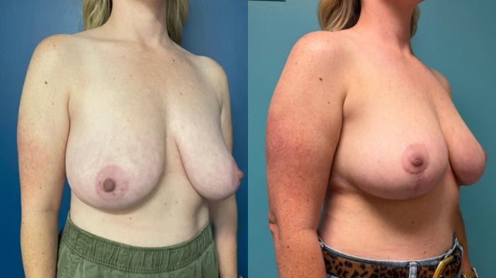 Breast Reduction Before & After Photo | San Francisco, CA | Kaiser Permanente Cosmetic Services