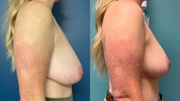 Breast Reduction Before & After Photo | San Francisco, CA | Kaiser Permanente Cosmetic Services