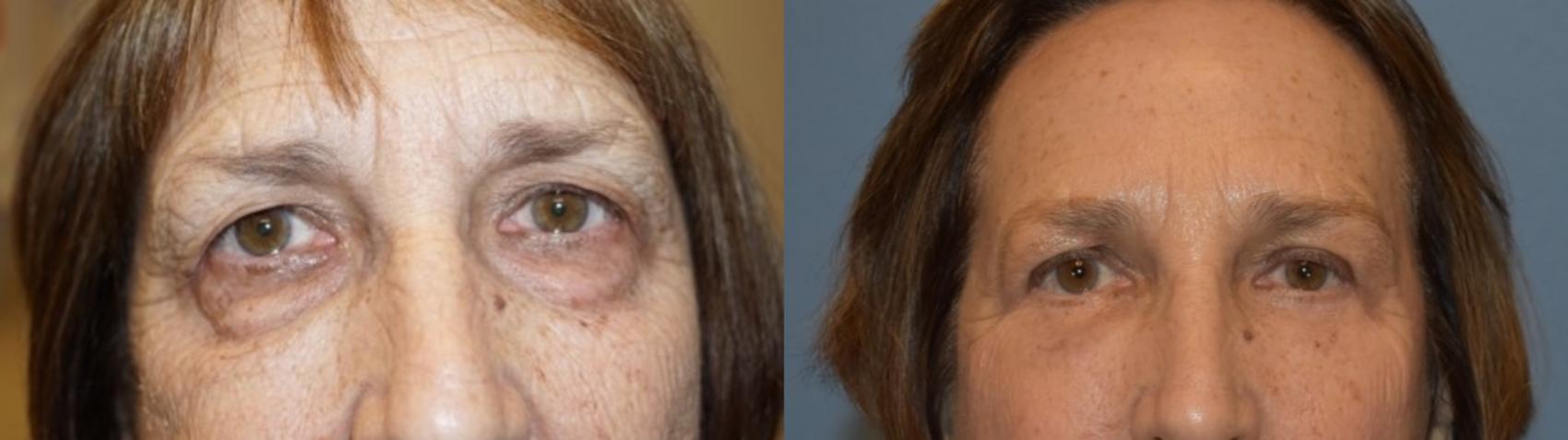 Brow Lift Before & After Photo | San Francisco, CA | Kaiser Permanente Cosmetic Services