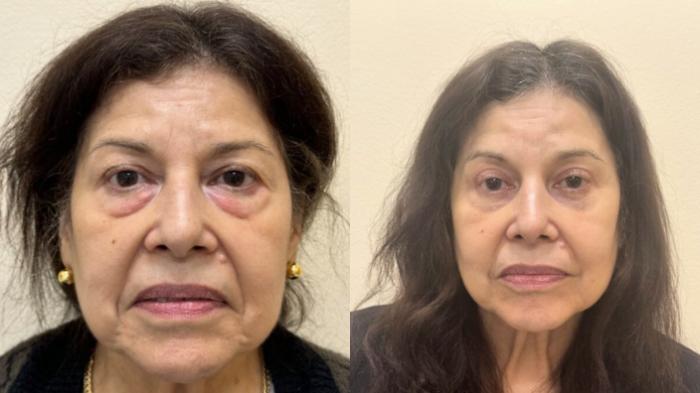 Brow Lift Before & After Photo | San Francisco, CA | Kaiser Permanente Cosmetic Services