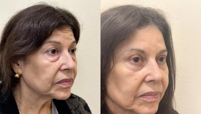 Brow Lift Before & After Photo | San Francisco, CA | Kaiser Permanente Cosmetic Services