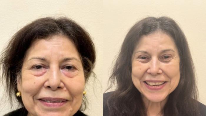 Brow Lift Before & After Photo | San Francisco, CA | Kaiser Permanente Cosmetic Services