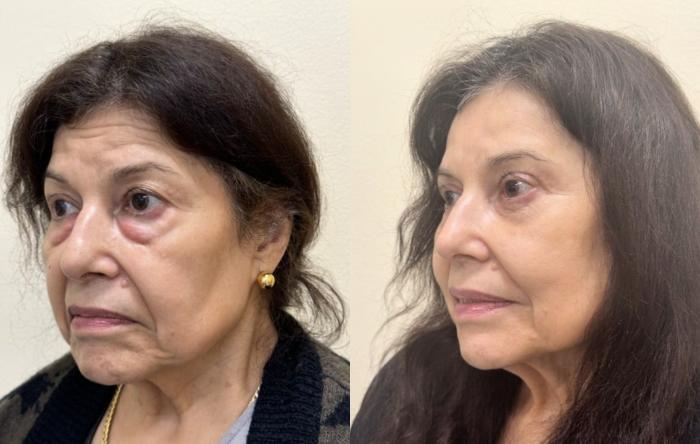 Brow Lift Before & After Photo | San Francisco, CA | Kaiser Permanente Cosmetic Services