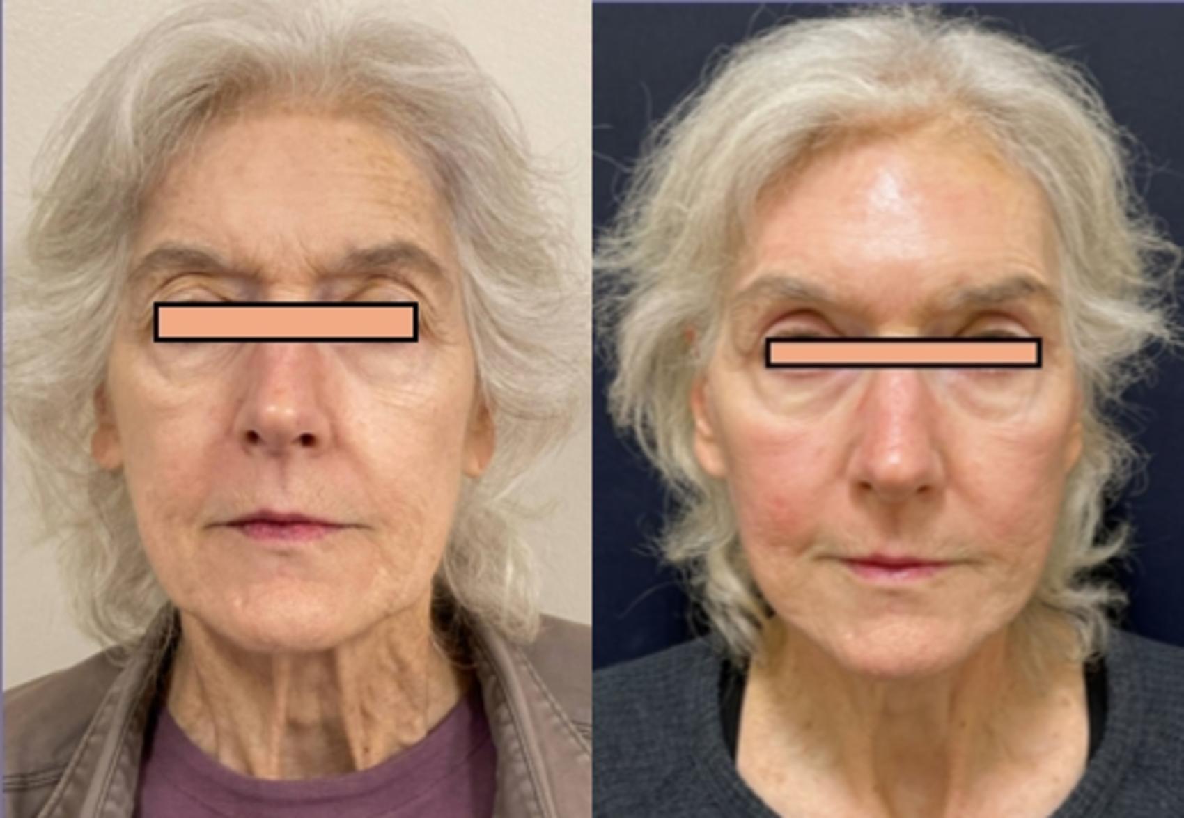 Brow Lift Before & After Photo | San Francisco, CA | Kaiser Permanente Cosmetic Services