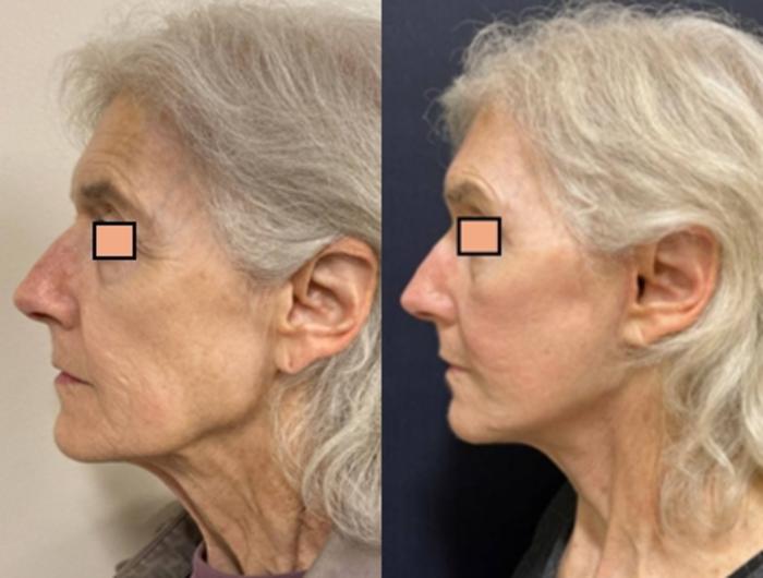 Brow Lift Before & After Photo | San Francisco, CA | Kaiser Permanente Cosmetic Services