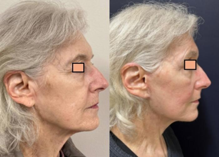 Brow Lift Before & After Photo | San Francisco, CA | Kaiser Permanente Cosmetic Services