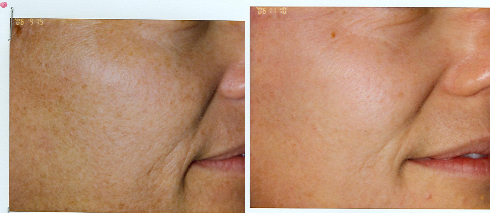 Chemical Peels Before & After Photo | San Francisco, CA | Kaiser Permanente Cosmetic Services