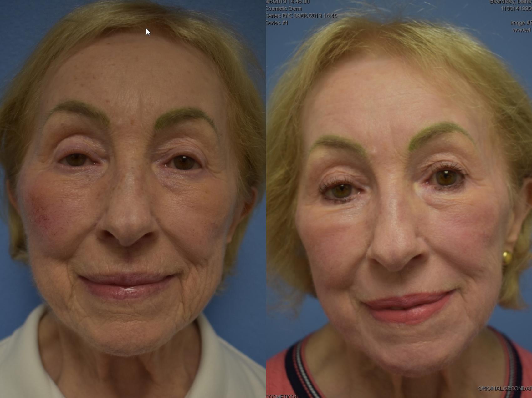 CO2 laser resurfacing Before & After Photo | San Francisco, CA | Kaiser Permanente Cosmetic Services