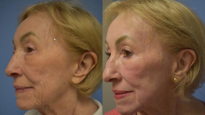 CO2 laser resurfacing Before & After Photo | San Francisco, CA | Kaiser Permanente Cosmetic Services