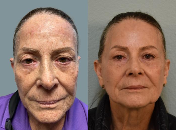 CO2 laser resurfacing Before & After Photo | San Francisco, CA | Kaiser Permanente Cosmetic Services