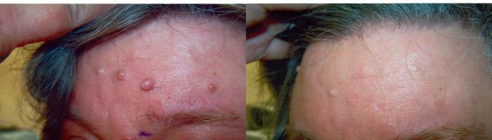 Cosmetic Removal of Moles & Skin Tags Before & After Photo | San Francisco, CA | Kaiser Permanente Cosmetic Services