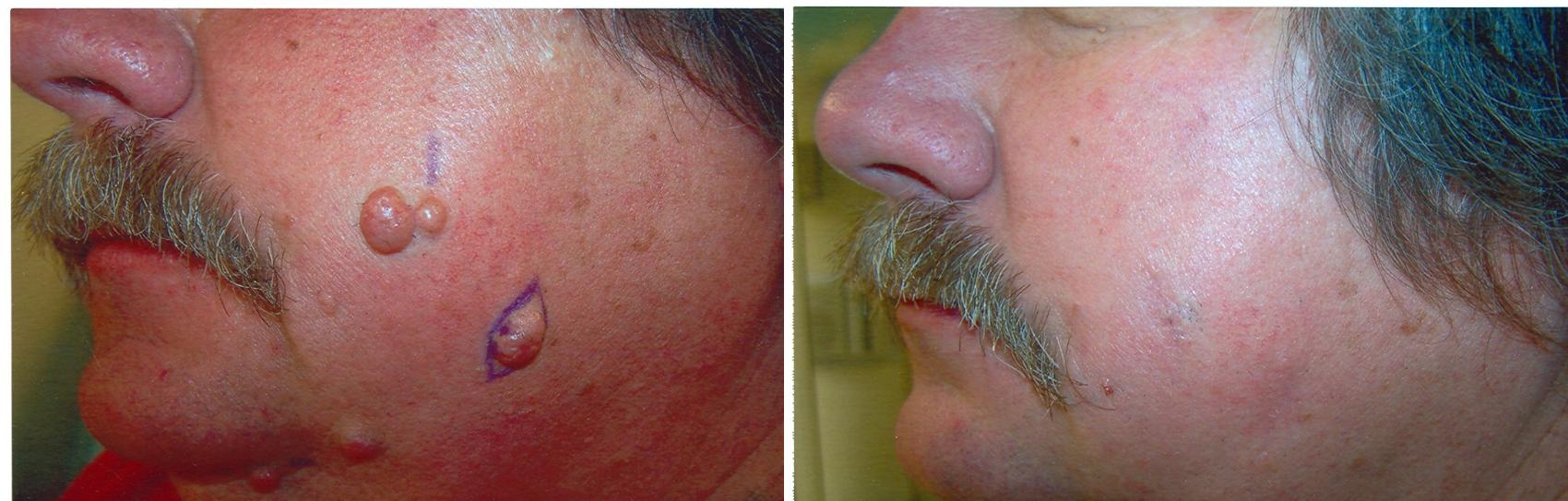 Cosmetic Removal of Moles & Skin Tags Before & After ...