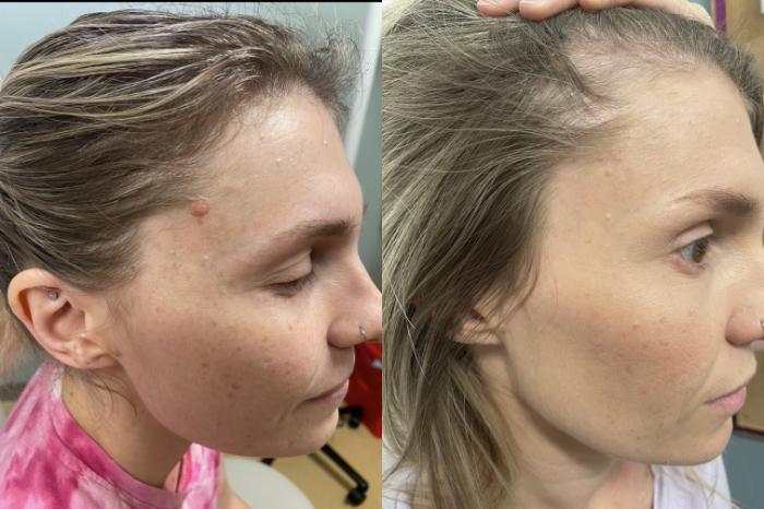 Mole Removal