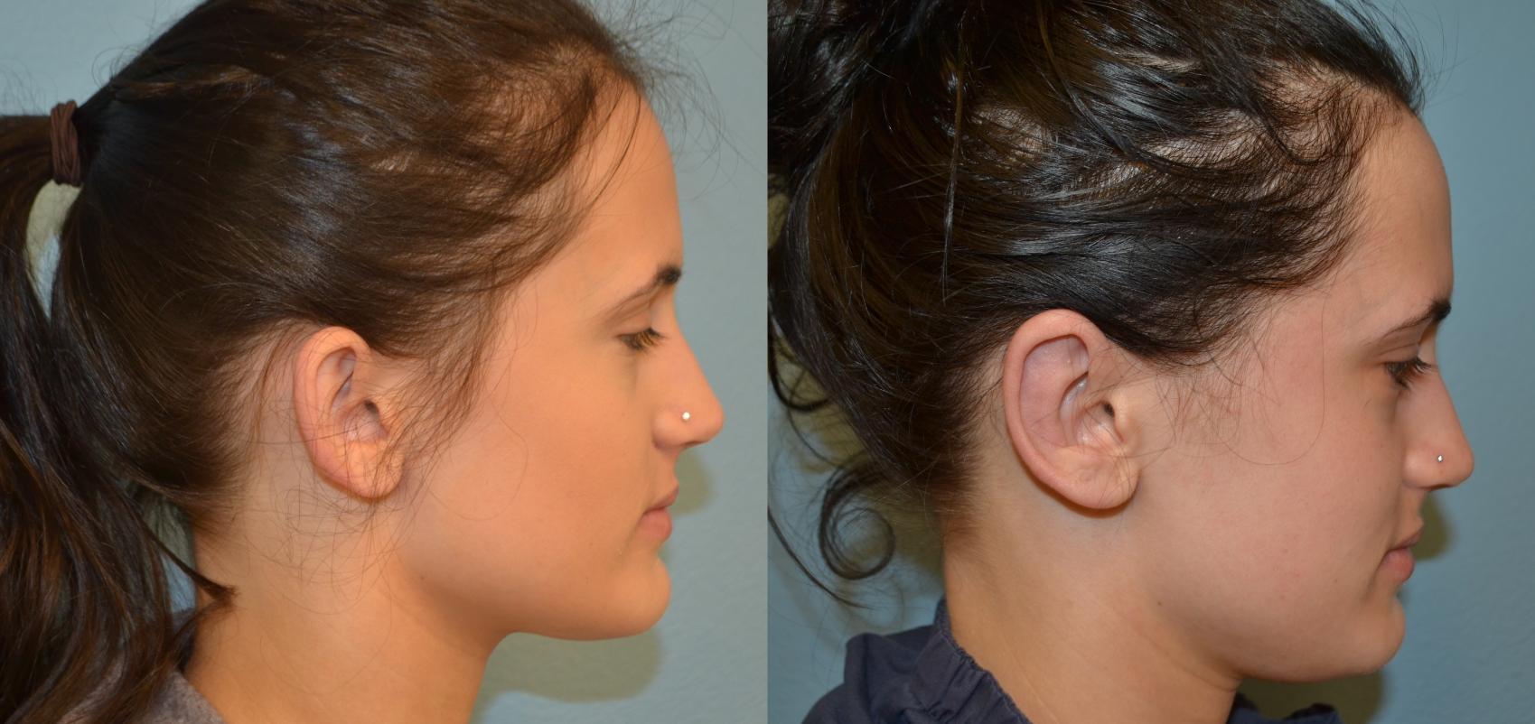 Ear Surgery Before & After Photo San Francisco, CA Kaiser Permanente Co...