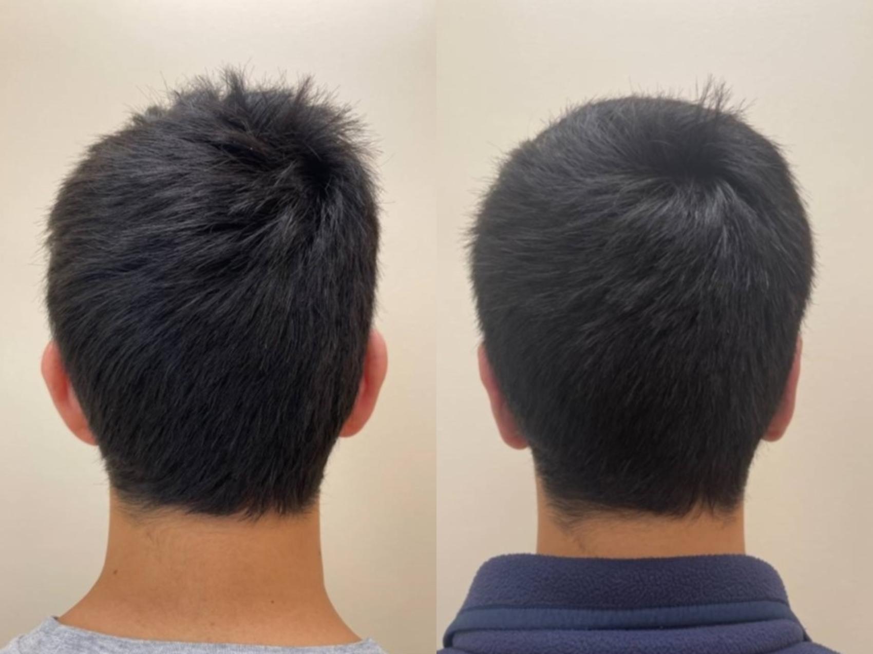 Ear Surgery Before & After Photos Patient 341 San Francisco, CA