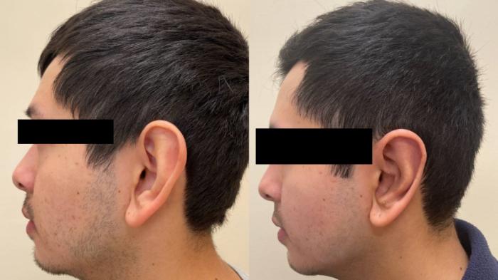 Ear Surgery Before & After Photo | San Francisco, CA | Kaiser Permanente Cosmetic Services