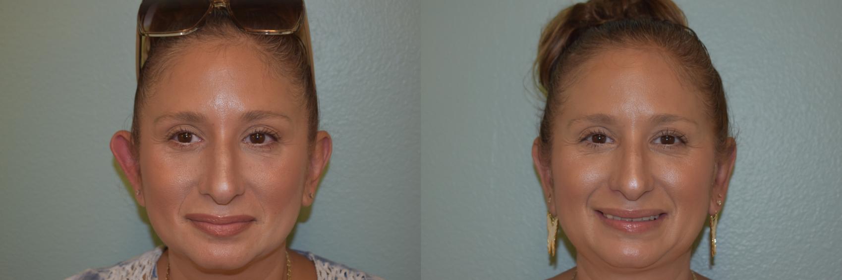 Ear Surgery Before & After Photo | San Francisco, CA | Kaiser Permanente Cosmetic Services