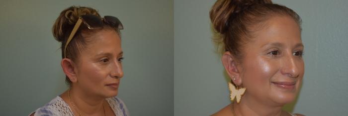 Ear Surgery Before & After Photo | San Francisco, CA | Kaiser Permanente Cosmetic Services