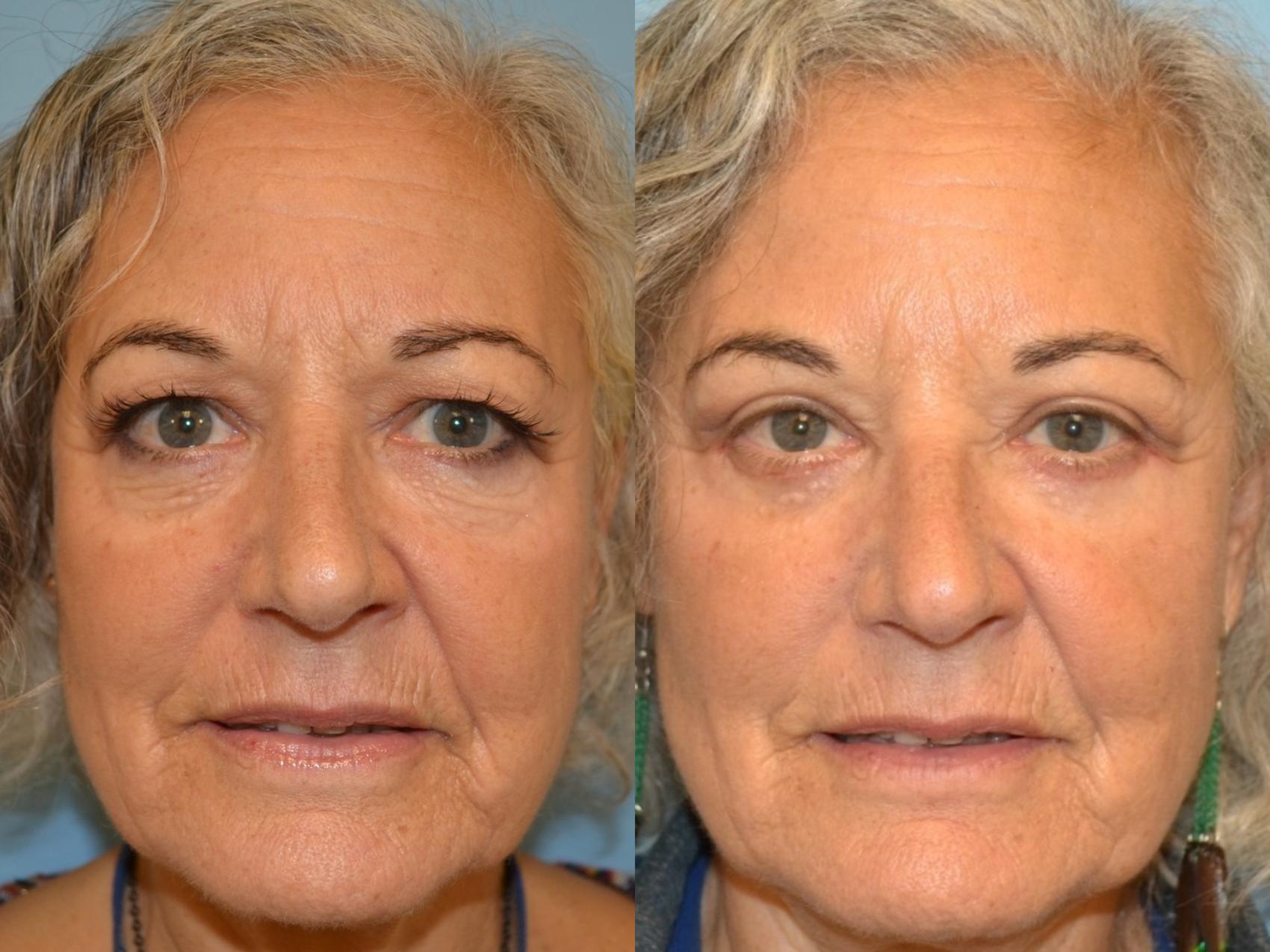 surgical reduction of the eyelids