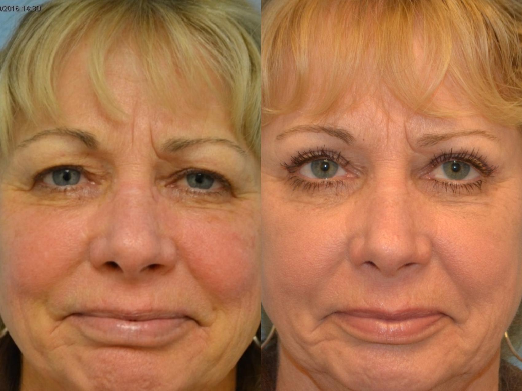 Eyelid Surgery Before & After Photos Patient 163 San