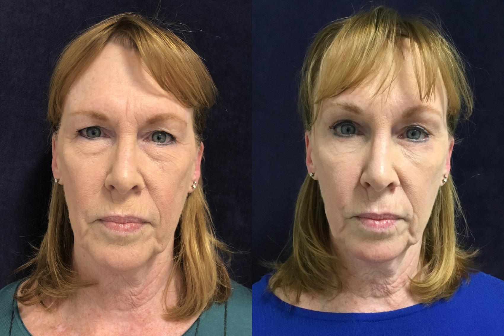 Eyelid Surgery Before & After Photo | San Francisco, CA | Kaiser Permanente Cosmetic Services