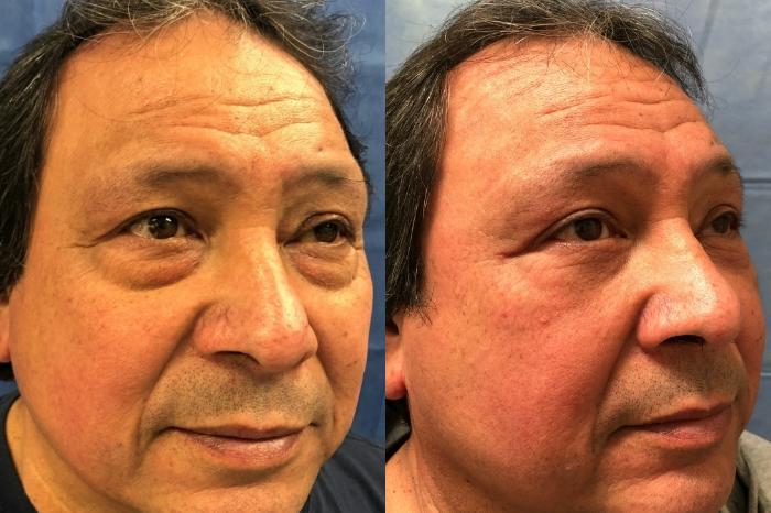Eyelid Surgery Before & After Photo | San Francisco, CA | Kaiser Permanente Cosmetic Services
