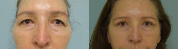 Eyelid Surgery Before & After Photo | San Francisco, CA | Kaiser Permanente Cosmetic Services