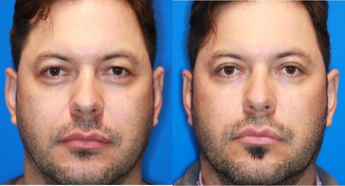 Eyelid Surgery Before & After Photo | San Francisco, CA | Kaiser Permanente Cosmetic Services