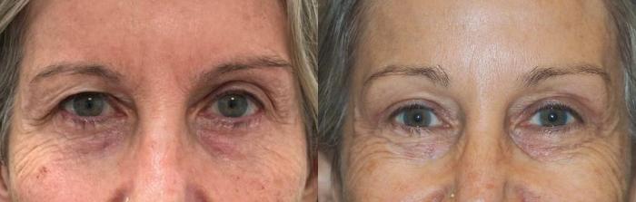 Eyelid Surgery Before & After Photo | San Francisco, CA | Kaiser Permanente Cosmetic Services