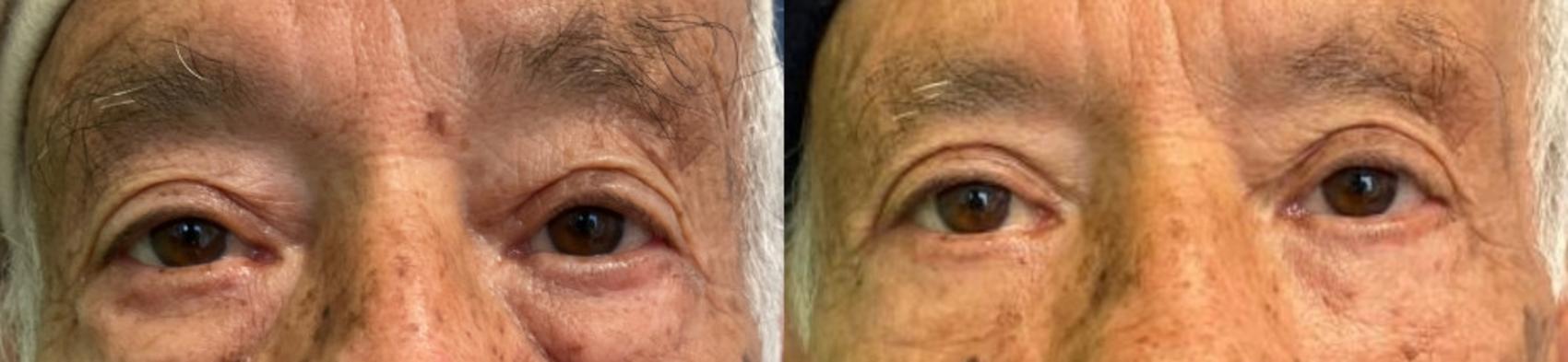Eyelid Surgery Before & After Photo | San Francisco, CA | Kaiser Permanente Cosmetic Services