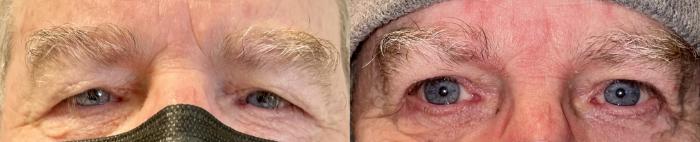 Eyelid Surgery Before & After Photo | San Francisco, CA | Kaiser Permanente Cosmetic Services