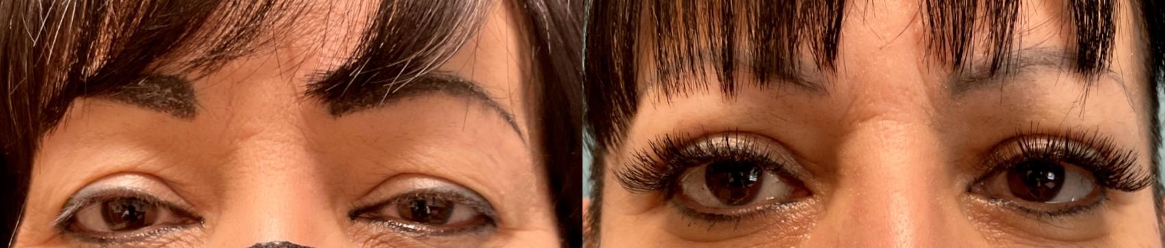 Eyelid Surgery Before & After Photo | San Francisco, CA | Kaiser Permanente Cosmetic Services