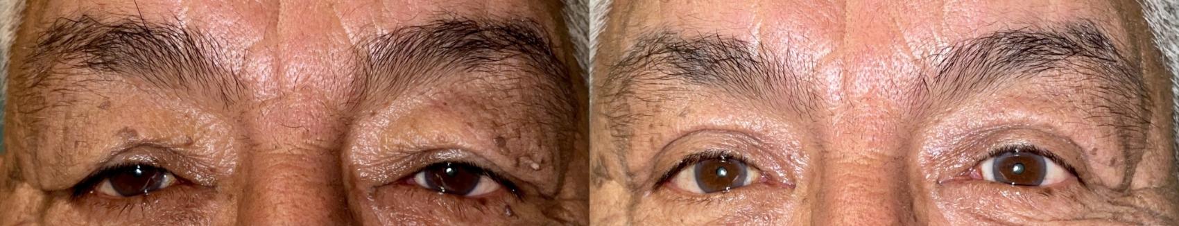 Eyelid Surgery Before & After Photo | San Francisco, CA | Kaiser Permanente Cosmetic Services