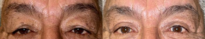 Eyelid Surgery Before & After Photo | San Francisco, CA | Kaiser Permanente Cosmetic Services