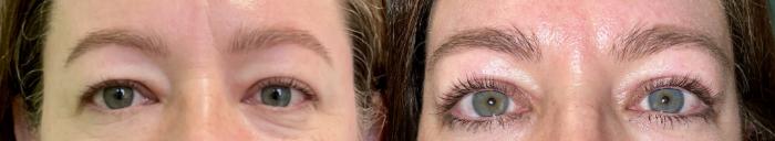 Eyelid Surgery Before & After Photo | San Francisco, CA | Kaiser Permanente Cosmetic Services