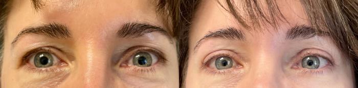 Eyelid Surgery Before & After Photo | San Francisco, CA | Kaiser Permanente Cosmetic Services