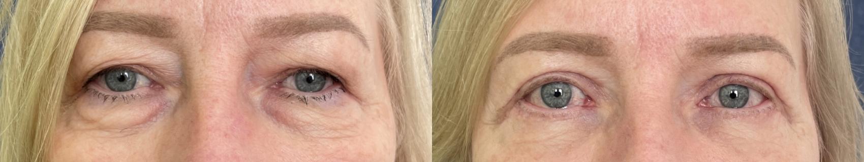 Eyelid Surgery Before & After Photo | San Francisco, CA | Kaiser Permanente Cosmetic Services