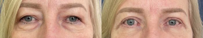 Eyelid Surgery Before & After Photo | San Francisco, CA | Kaiser Permanente Cosmetic Services