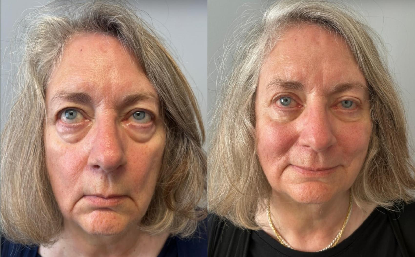 Eyelid Surgery Before & After Photo | San Francisco, CA | Kaiser Permanente Cosmetic Services