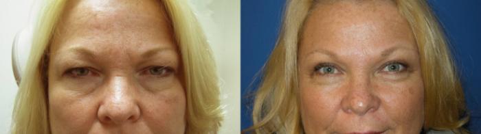 Eyelid Surgery Before & After Photo | San Francisco, CA | Kaiser Permanente Cosmetic Services