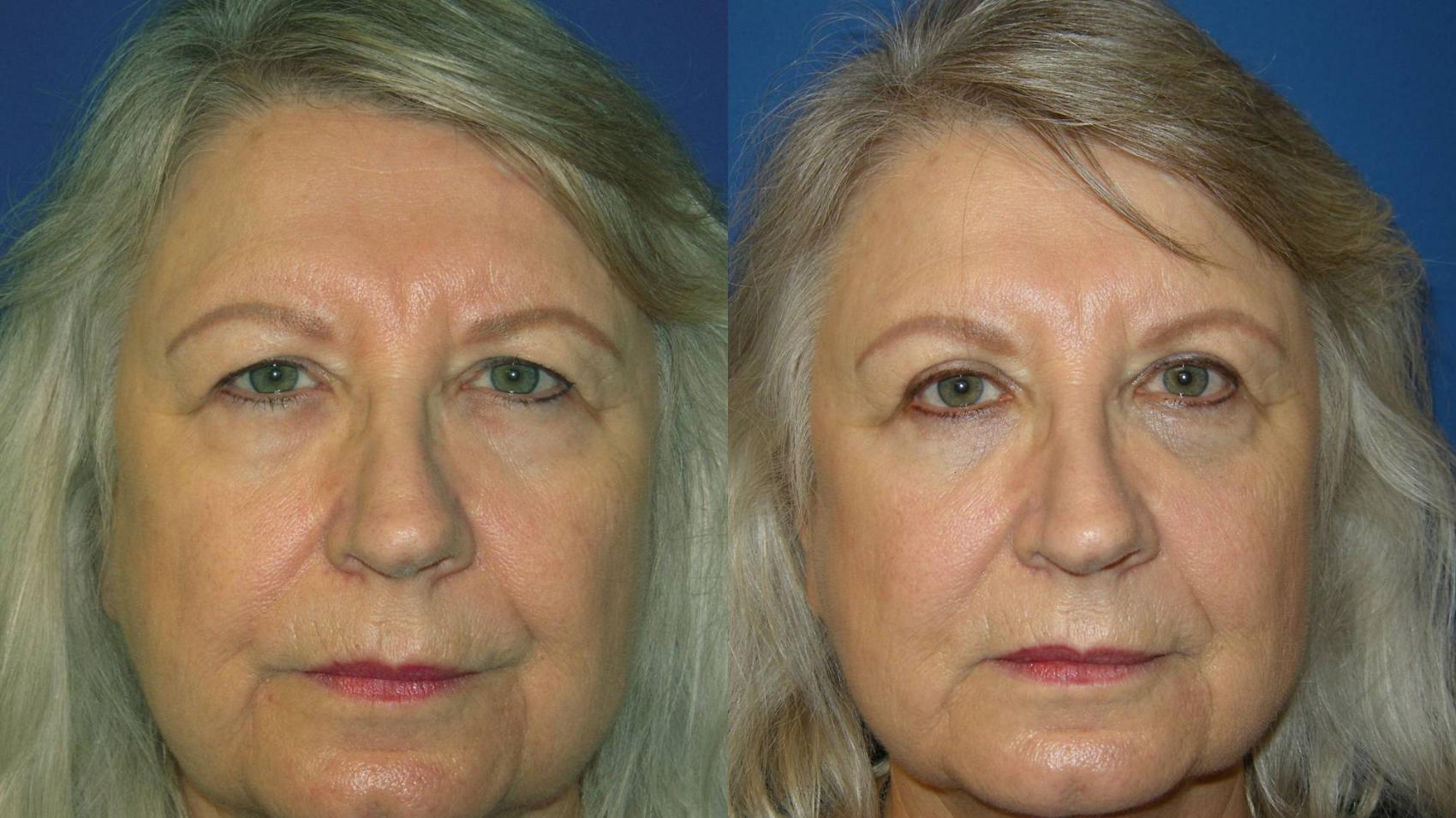 upper eyelid surgery before and after