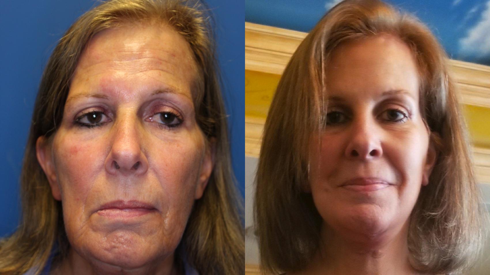 Facelift Before & After Photo | San Francisco, CA | Kaiser Permanente Cosmetic Services