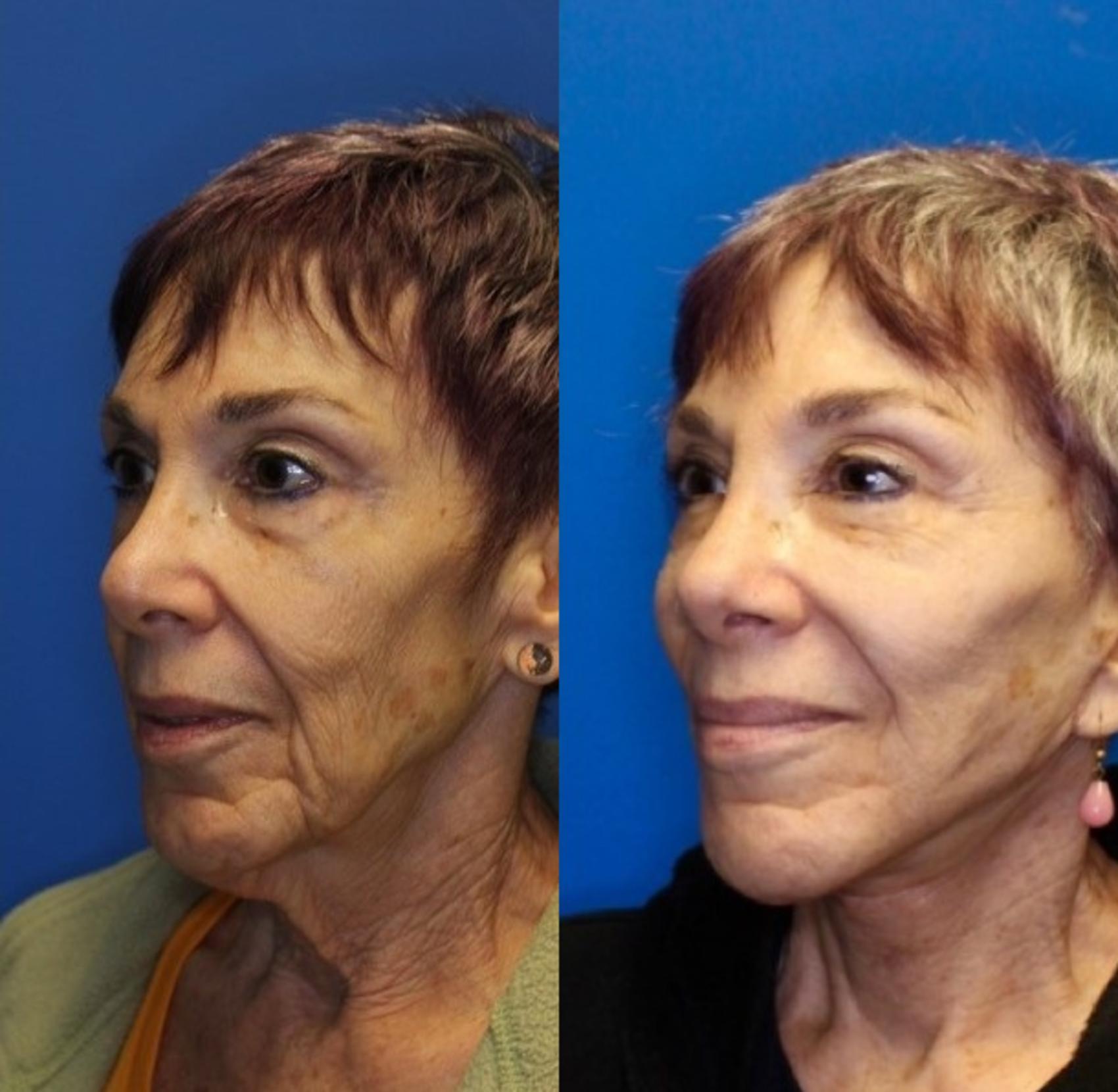 Facelift Before & After Photos Patient 229 San Francisco, CA Kaiser