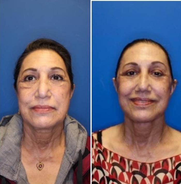 Facelift Before & After Photo | San Francisco, CA | Kaiser Permanente Cosmetic Services