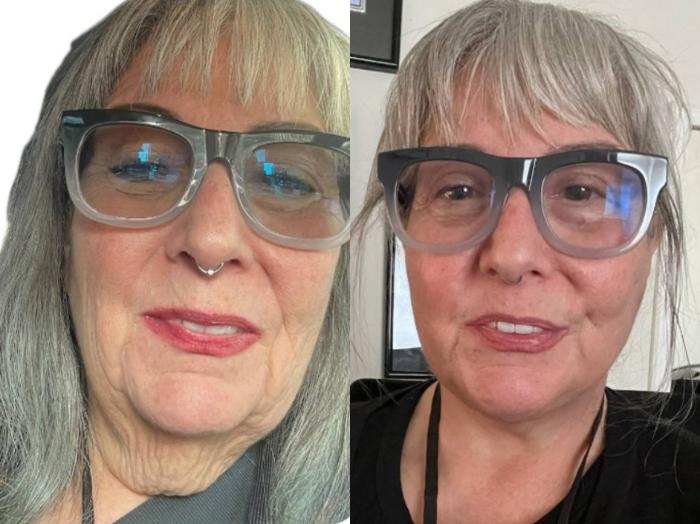 Facelift Before & After Photo | San Francisco, CA | Kaiser Permanente Cosmetic Services