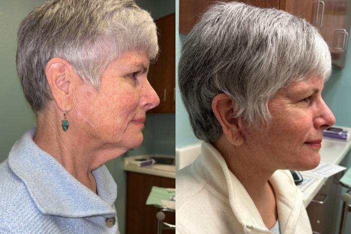 Facelift Before & After Photo | San Francisco, CA | Kaiser Permanente Cosmetic Services