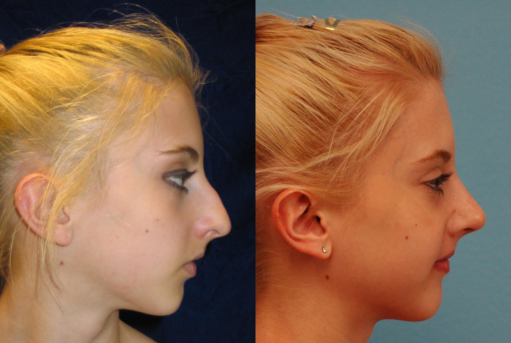 Facial Implants Before & After Photo | San Francisco, CA | Kaiser Permanente Cosmetic Services