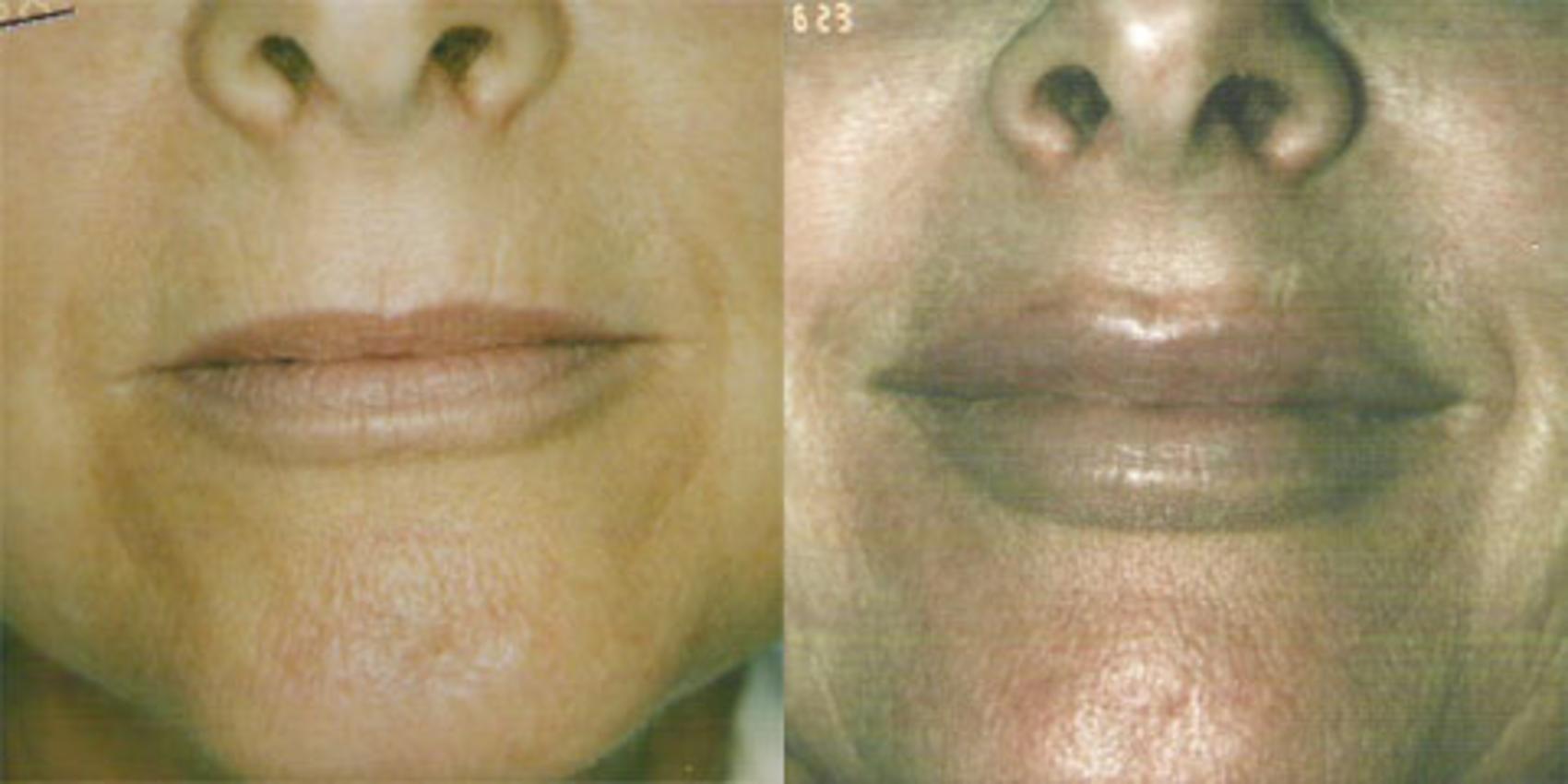Fillers (JUVÉDERM®, JUVÉDERM VOLUMA®, Restylane®) Before & After Photo | San Francisco, CA | Kaiser Permanente Cosmetic Services