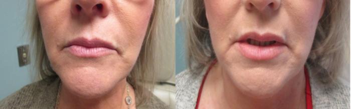 Fillers (JUVÉDERM®, JUVÉDERM VOLUMA®, Restylane®) Before & After Photo | San Francisco, CA | Kaiser Permanente Cosmetic Services